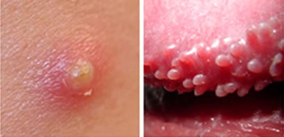 Will pearly penile papules go away